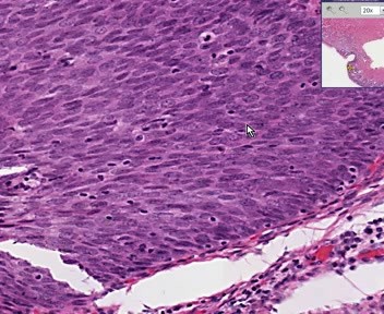 Cervix - Squamous Metaplasia