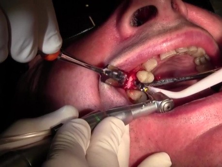 BSB Implant Placement #4 into Mineross Regenerated Bone