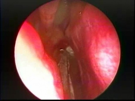 Large Choanal Polyp - Endoscopic Removal
