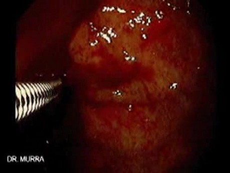 Gastric Varices (12 of 25)