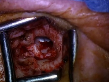 Laser Stapedotomy