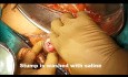 Partial Penectomy for Penile Cancer
