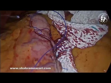 Gastric Twist After Sleeve Gastrectomy