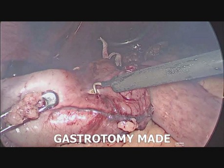 Laparoscopic Revisional Bariatric Surgery (Sleeve Gastrectomy  to OAGB) 
