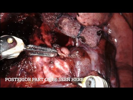 Right Sided S6 Segmentectomy Using the Robotic System