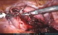 Myomectomy