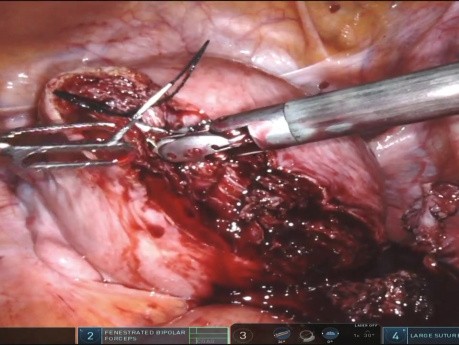Myomectomy