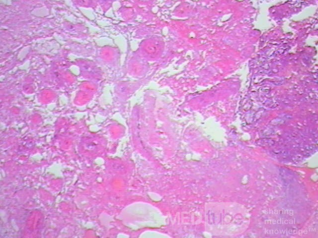 Tubulo - Villous Rectal Adenoma - Endoscopy (25 of 35)