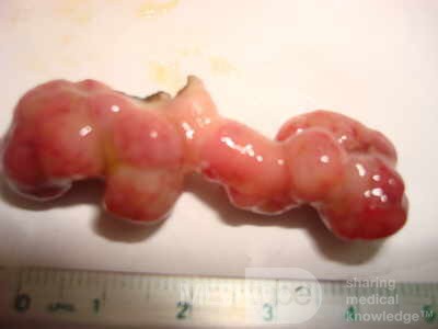 Colonoscopic Polypectomy (21 of 29)