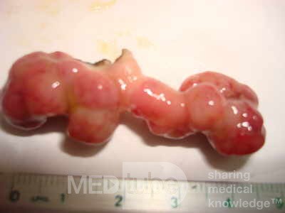 Colonoscopic Polypectomy (21 of 29)