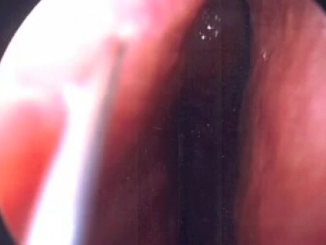 Septoplasty - Endoscopy