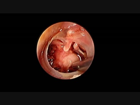 Endoscopic Exploration of the Middle Ear 