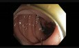 Colonoscopy - Sigmoid Polyp - 2 Find dependent position