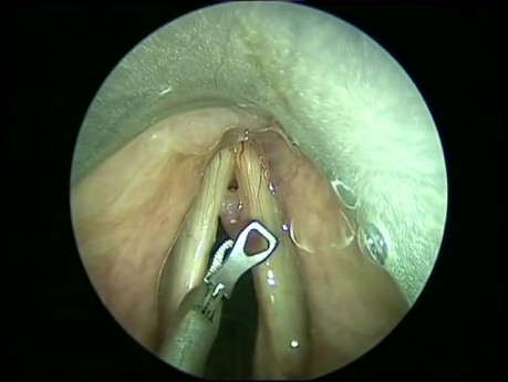 Intraoperative Assessment-Vocal Fold Polyp Part I