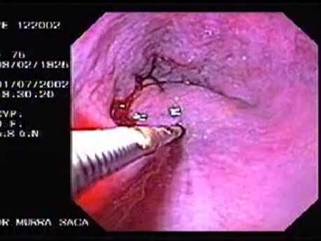 Hemorrhage due status post rubber band ligation of esophageal varices (13 of 25)