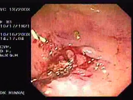 Tubulo - Villous Adenoma - Endoscopy (9 of 28)