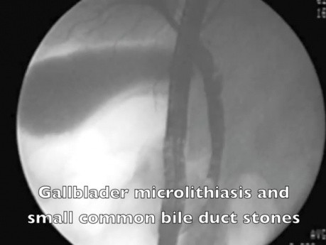 Pancreatitis- endooscopic treatment