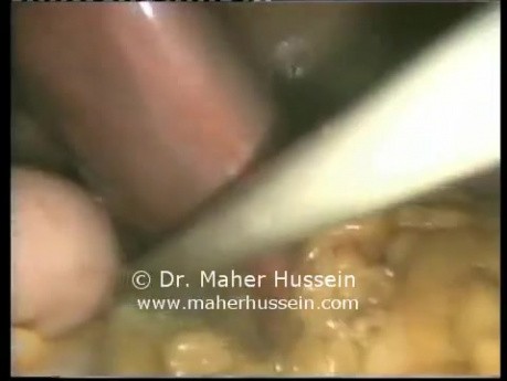 Nissen Fundoplication