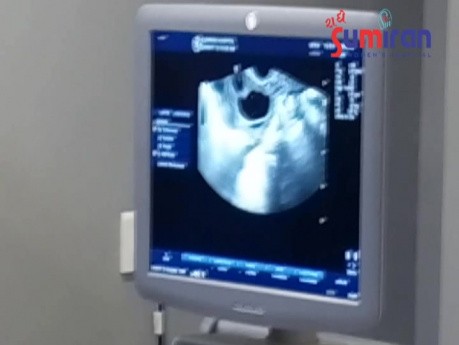 Ovum Pick Up - Very Safe Technique