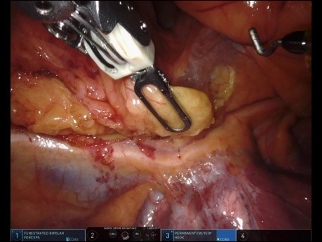 Robotic Thymectomy for a 6cm Thymoma