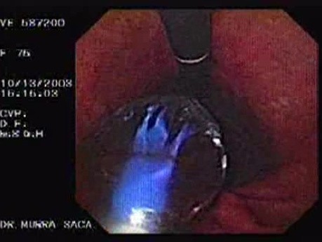 Achalasia - Presentation of Baloon in Retroflexed Image