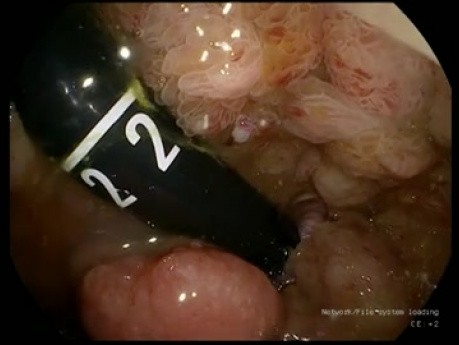 ESD of Circumferential Rectal Polyp – Total Rectal Mucosal Endoscopic Resection