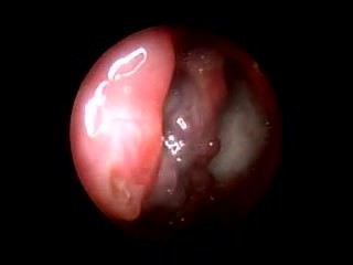 Haemangioma Of Oropharynx