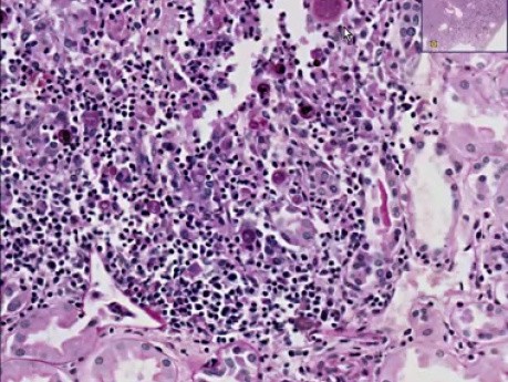 Coccidiodomycosis