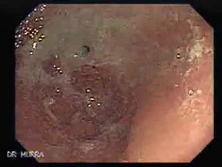 Adenocarcinoma of the Cardias - 91 Years-Old Male