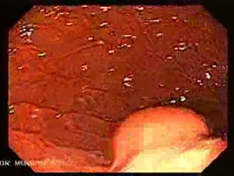 GIST With Ulcerated Lesion (2 of 6)