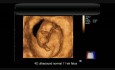 4D Ultrasound Normal 11 wk Fetus
