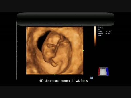 4D Ultrasound Normal 11 wk Fetus