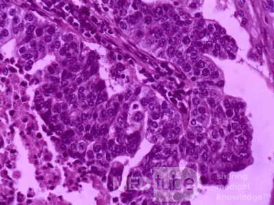 Gallbladder Adenocarcinoma and litiasis (7 of 13)