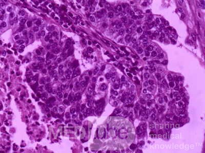 Gallbladder Adenocarcinoma and litiasis (7 of 13)