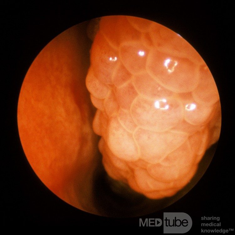 Tuberculosis of the Inferior Turbinate