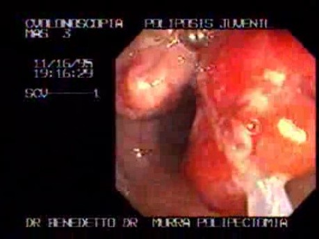 Non Familial Juvenile Polyposis Of The Colon (3 of 37)