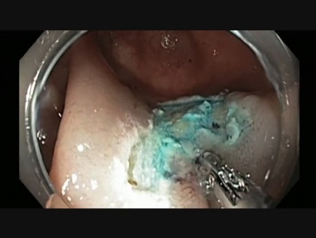 Colonoscopy - IC Valve Polyp EMR