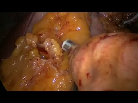 Laparoscopic Left Pancreatectomy