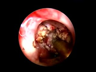 Rhinosporidiosis