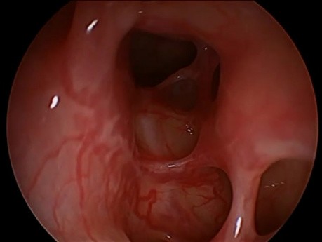 Functional Endoscopic Sinus Surgery (FESS)- Post-Endoscopical Nasal Cavity Appearance