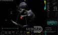 Ostium Secundum Atrial Septal Defect (ASD)