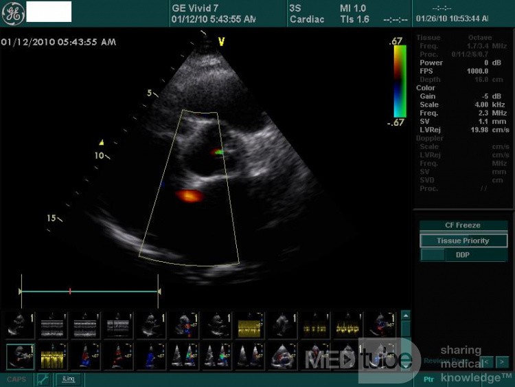 Ostium Secundum Atrial Septal Defect (ASD)