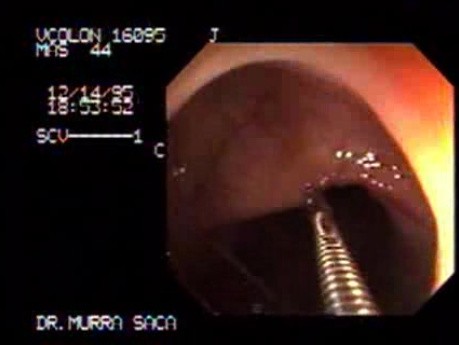 Flat Ulcerated Tubular Adenoma