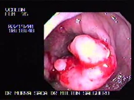Ulcerated Annular Adenocarcinoma