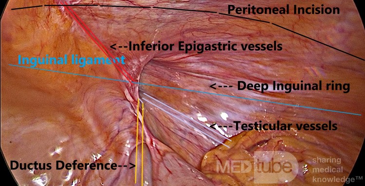 Landmarks in Laparoscopic TAPP Hernia Exploration
