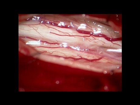 Syringomyelia