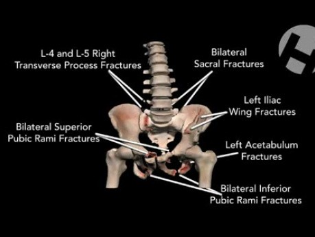 Pelvic Injuries
