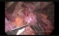 Laparoscopic Heller Myotomy with Dor Fundoplication for Achalasia
