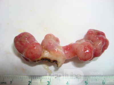 Colonoscopic Polypectomy (22 of 29)