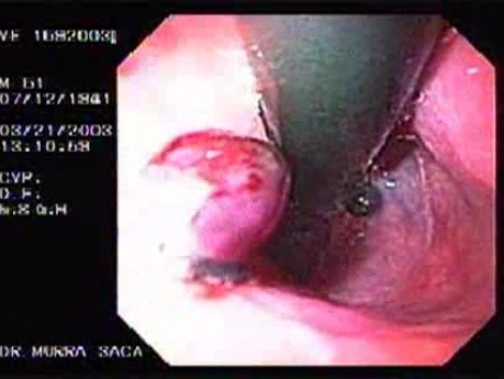 Banding of Esophageal Varices - Presence of Four Banded Varices
